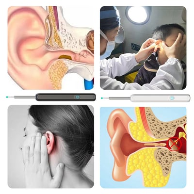 Smart Ear Wax Remover with HD Camera & LED Lights